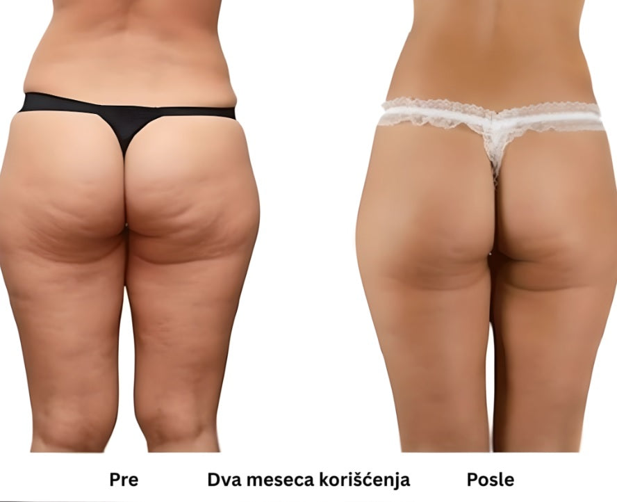 Flasteri za tretman donjih ekstremiteta